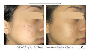 Acne Treatment System