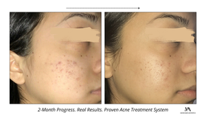 Acne Treatment System